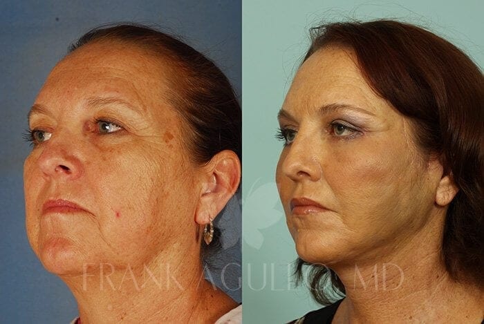 Face Lift Before and After 4
