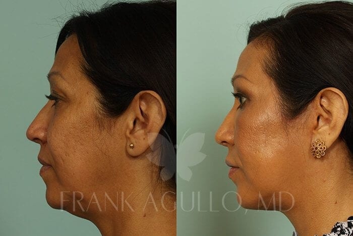 Face Lift Before and After 2