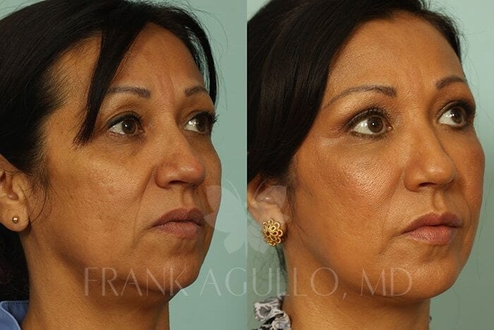 Face Lift Before and After 3
