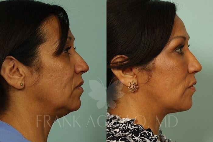 Face Lift Before and After 4
