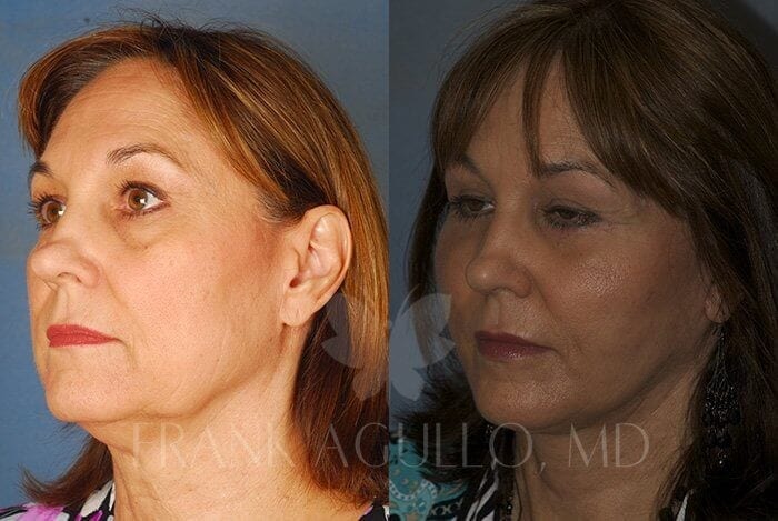 Face Lift Before and After 2