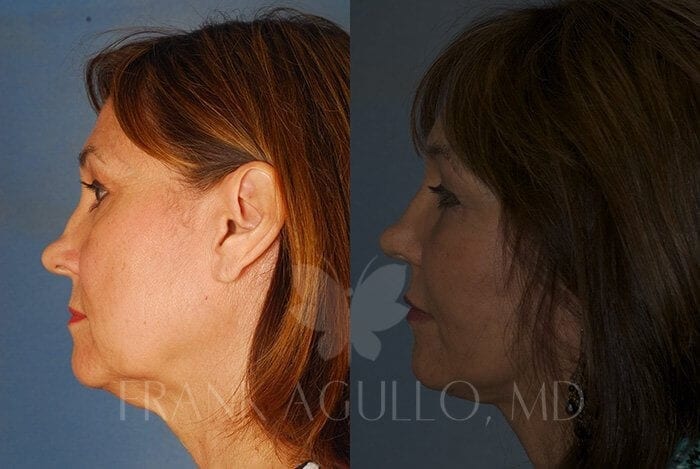 Face Lift Before and After 3