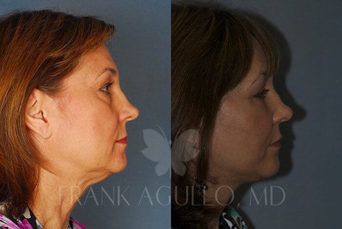 Face Lift Before and After 4
