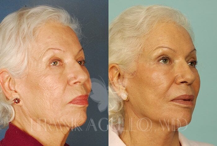 Face Lift Before and After 2