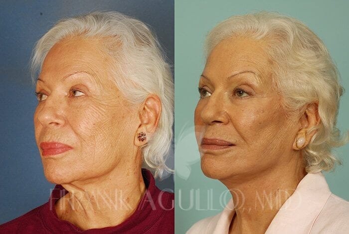 Face Lift Before and After 3