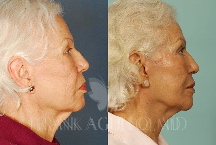 Face Lift Before and After 4