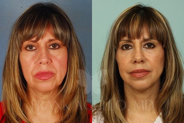 Face Lift Before and After 16