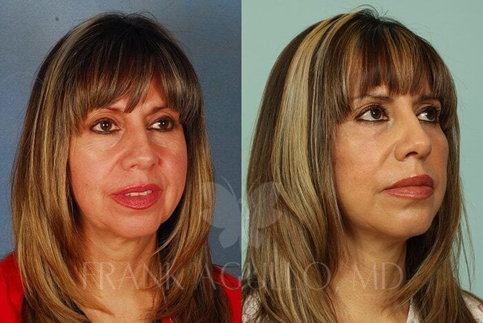 Face Lift Before and After 2