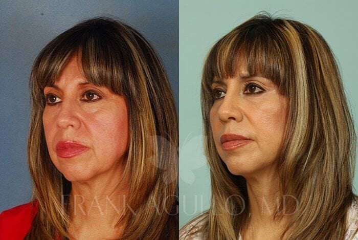 Face Lift Before and After 3