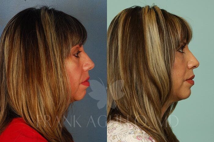 Face Lift Before and After 4