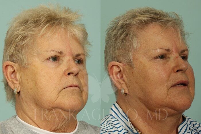 Face Lift Before and After 2