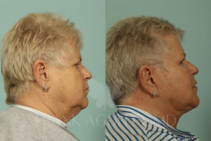 Face Lift Before and After 3