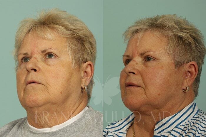 Face Lift Before and After 4