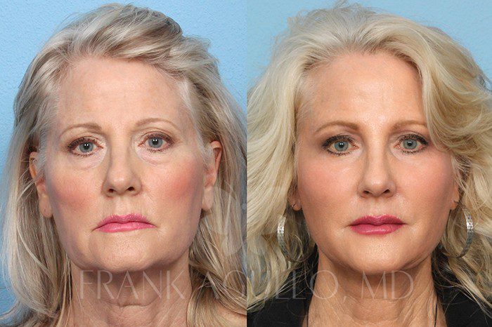 Neck Lift Before and After 2