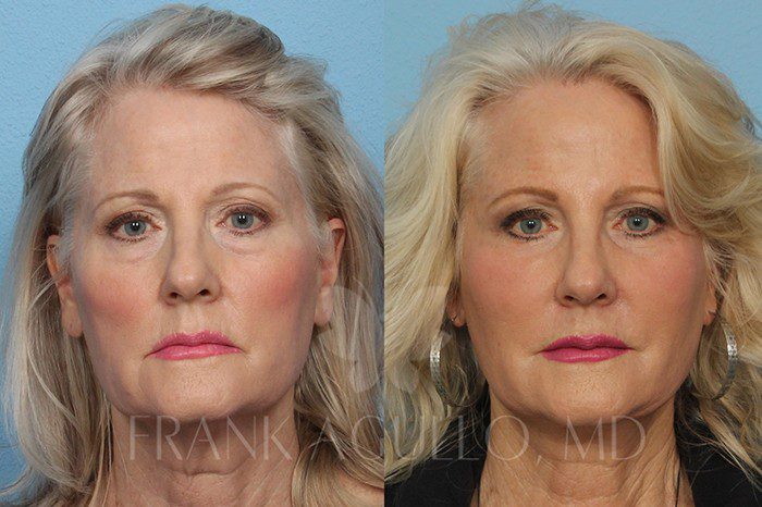 Face Lift Before and After 4