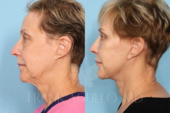 Neck Lift Before and After 3