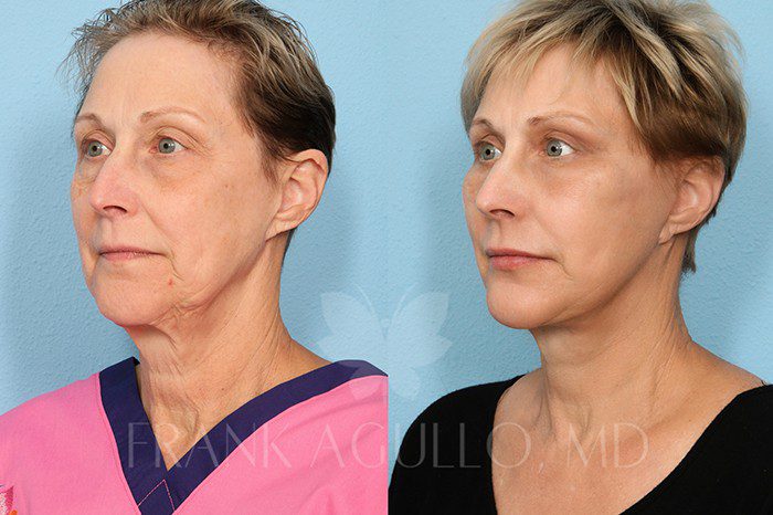 Neck Lift Before and After 2