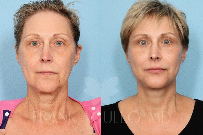 Face Lift Before and After 3