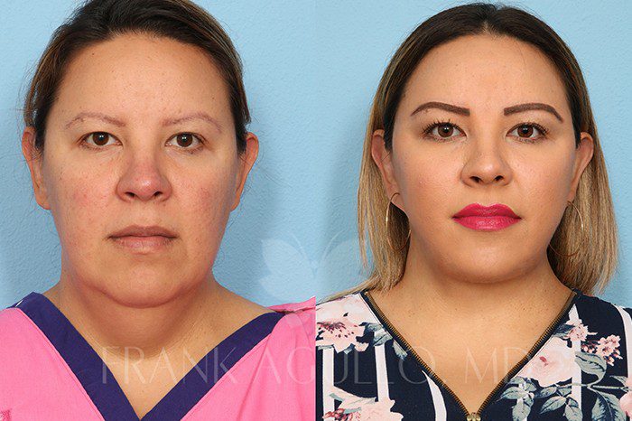 Face Lift Before and After 2