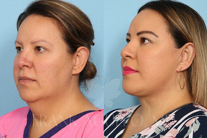 Neck Lift Before and After 2