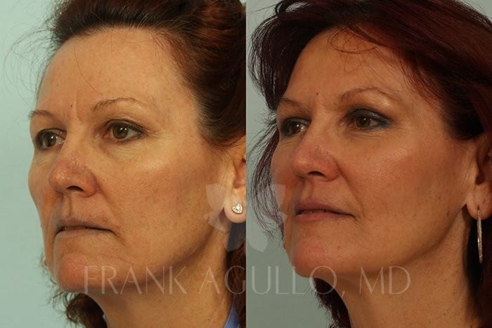 Fat Injections Before and After 2