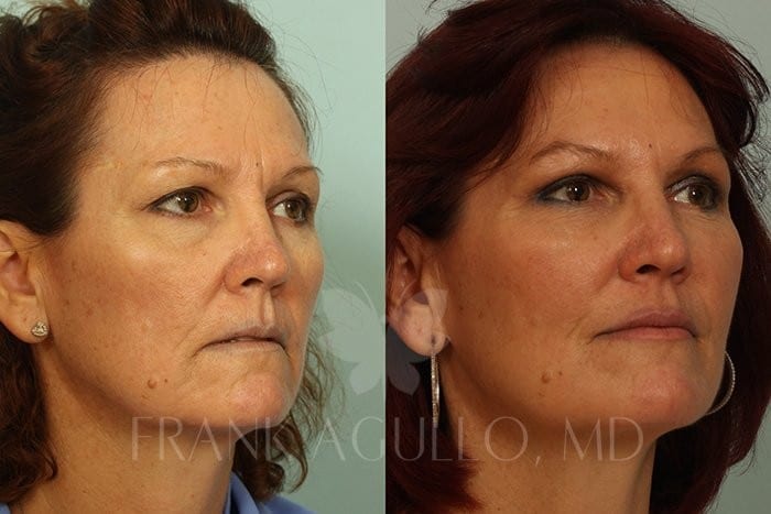 Fat Injections Before and After 3