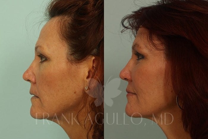 Fat Injections Before and After 4