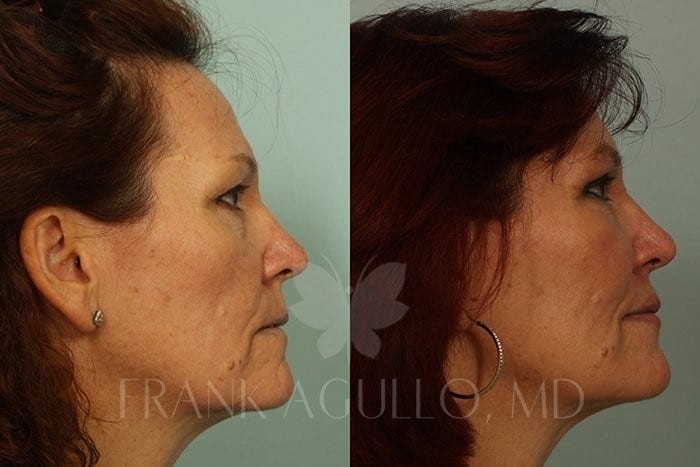 Fat Injections Before and After 5