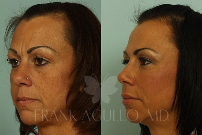 Fat Injections Before and After 2