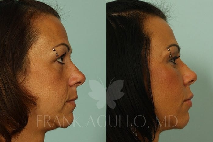 Fat Injections Before and After 3