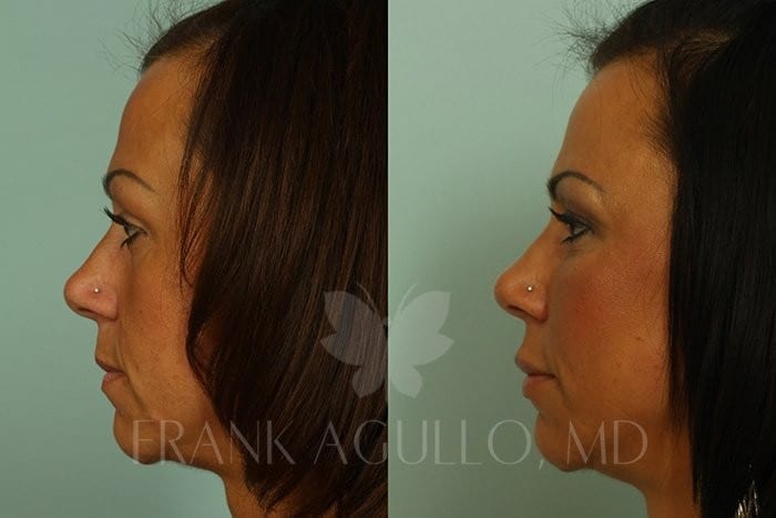 Fat Injections Before and After 4