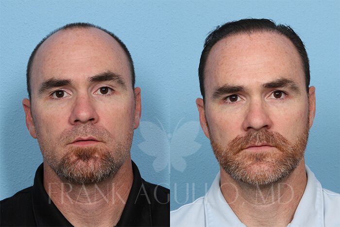 Hair Transplant Before and After 2