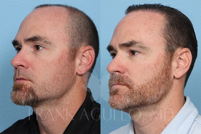 Hair Transplant Before and After 2