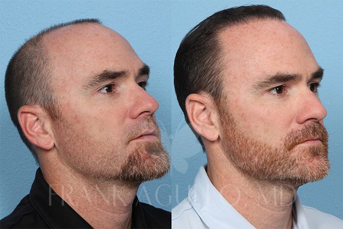 Hair Transplant Before and After 3