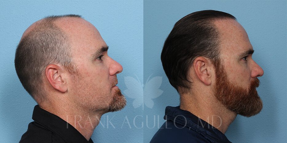 Hair Transplant Before and After 4