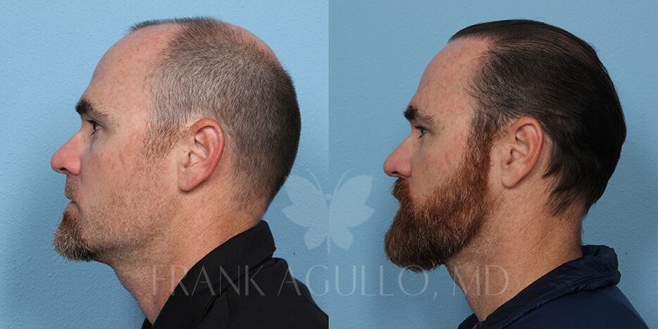 Hair Transplant Before and After 5