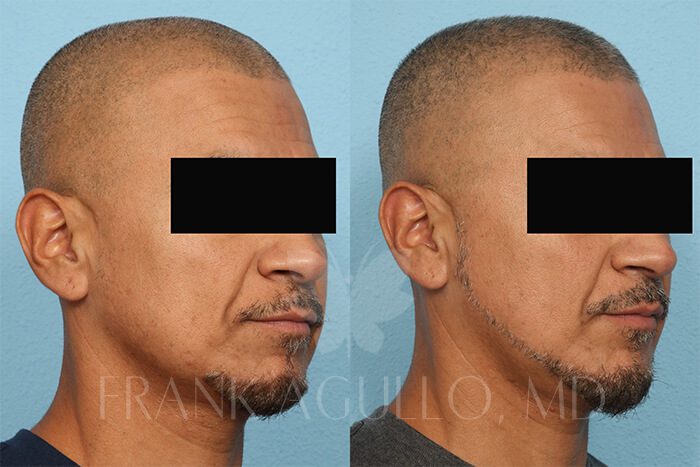 Hair Transplant Before and After 2