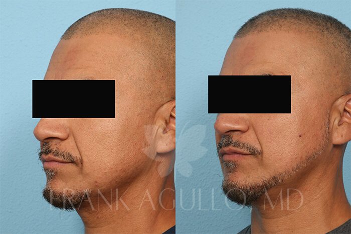 Hair Transplant Before and After 3