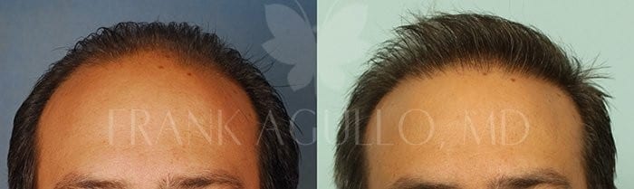 Hair Transplant Before and After 14