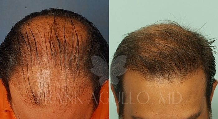 Hair Transplant Before and After 2