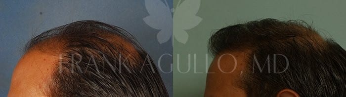Hair Transplant Before and After 3