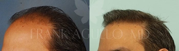 Hair Transplant Before and After 4