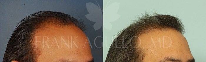 Hair Transplant Before and After 5
