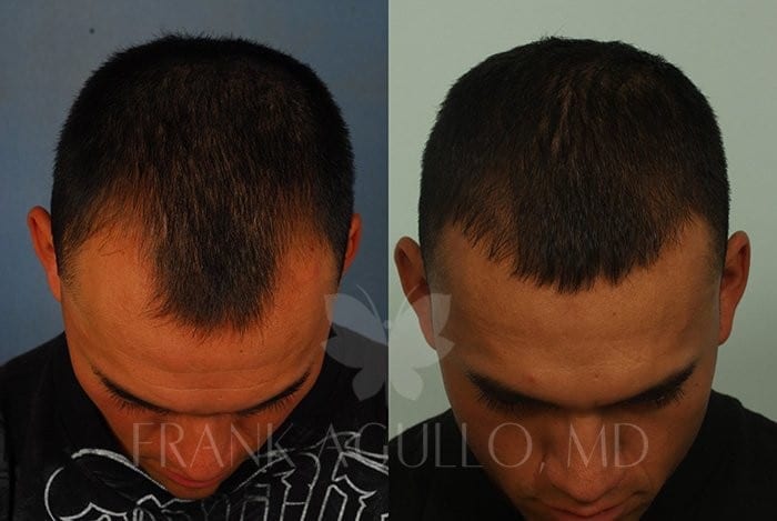 Hair Transplant Before and After 13