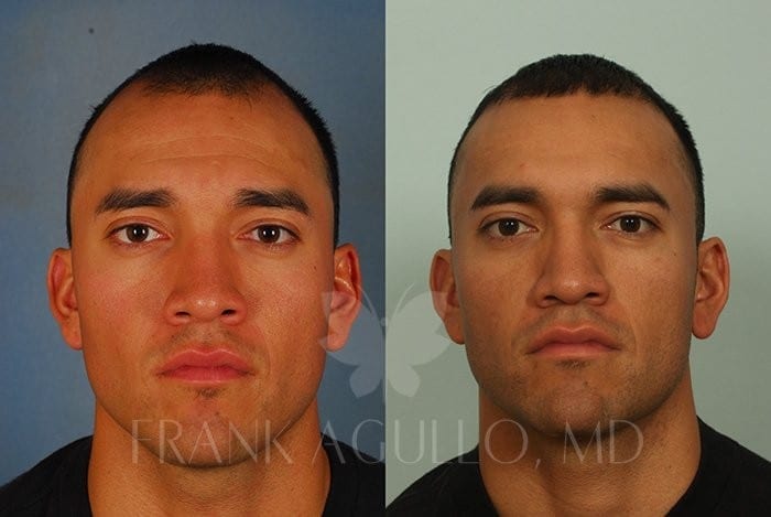 Hair Transplant Before and After 2