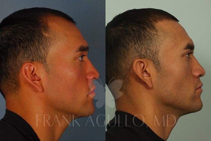 Hair Transplant Before and After 3