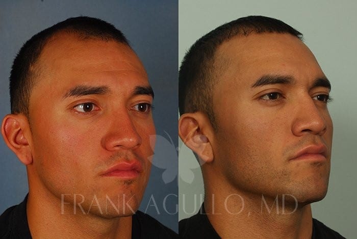 Hair Transplant Before and After 4