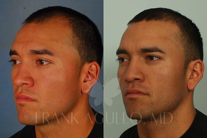 Hair Transplant Before and After 5