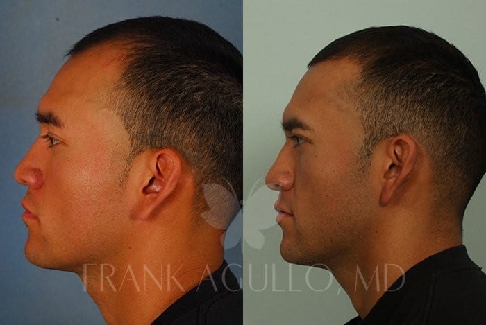 Hair Transplant Before and After 6