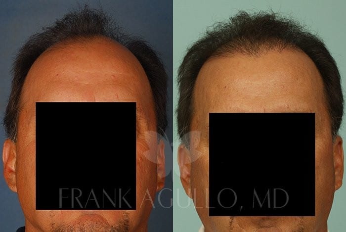 Hair Transplant Before and After 12